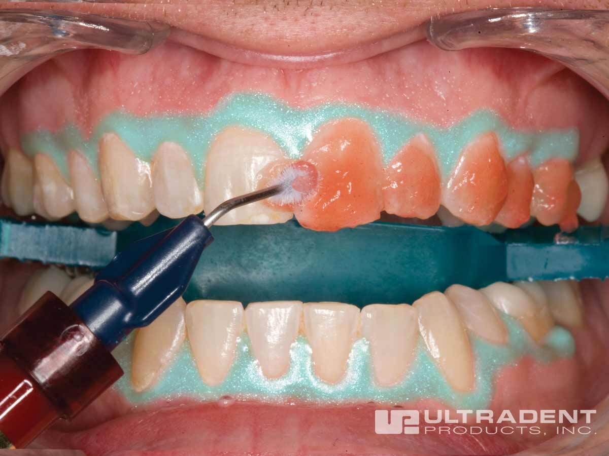 whitening_office_opal02